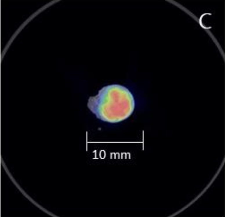 Imaging Case 7: Gastroenteropancreatic neuro-endocrine tumor