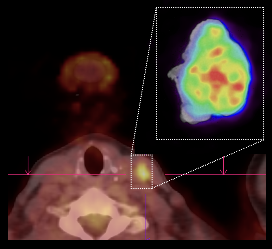 Imaging Case 9: Papillary thyroid carcinoma