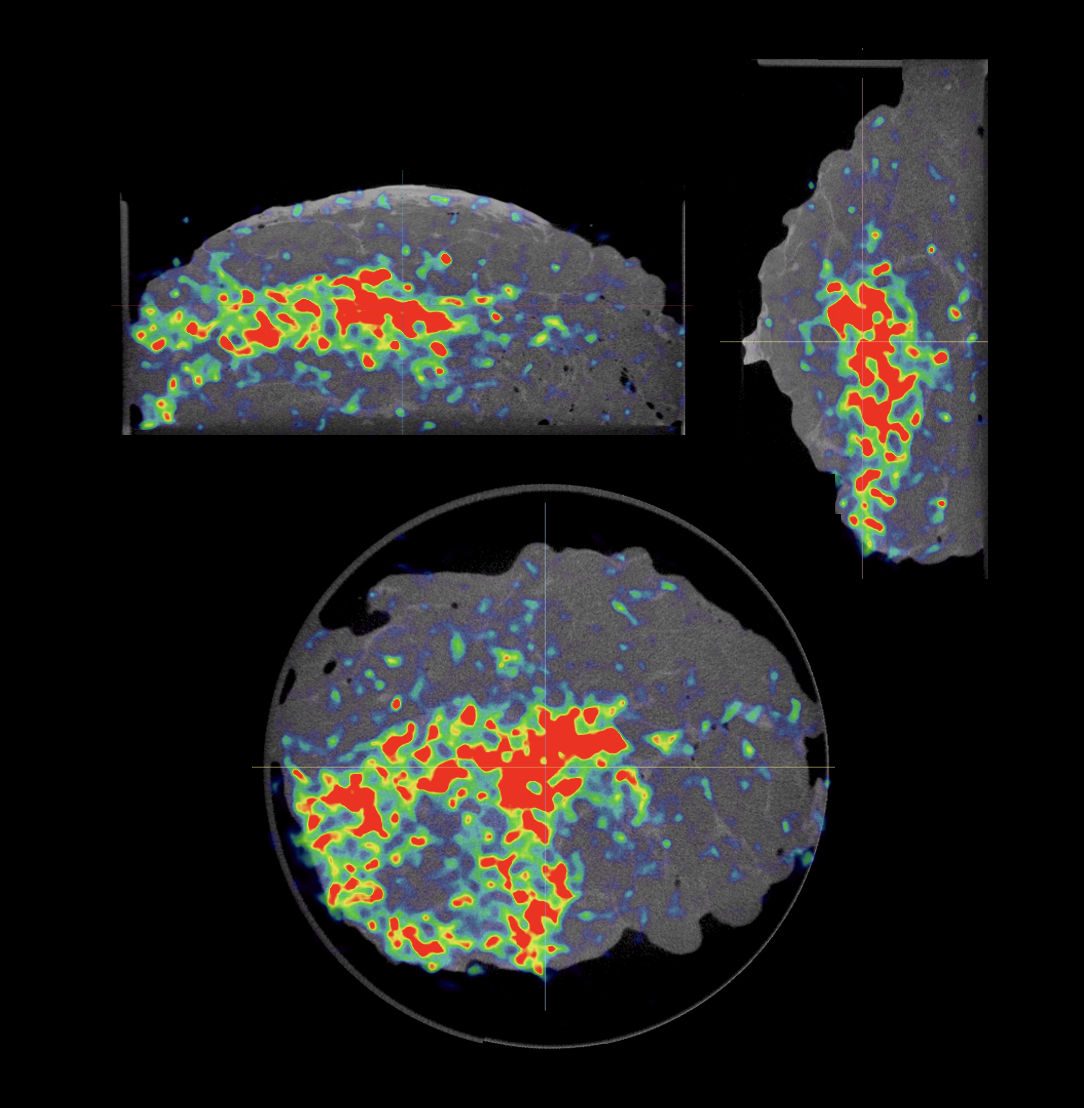 Imaging Case 12:Breast cancer – Invasive Lobular Carcinoma