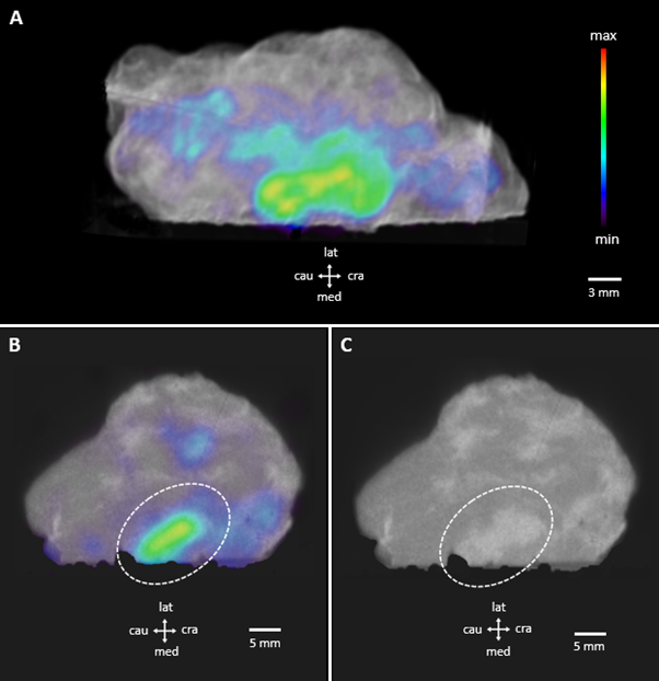 Imaging Case 3: Breast - Ductal carcinoma in situ - Xeos