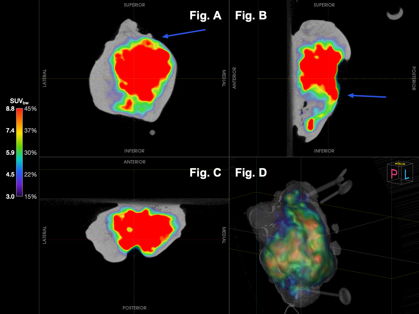 Imaging Case 34 Head &amp; Neck Cancer - Right Oropharyngeal Squamous Cell Carcinoma
