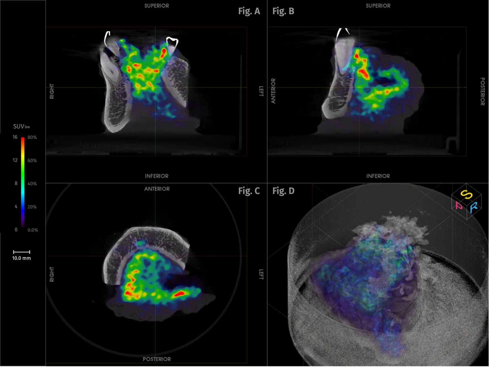 Imaging Case 35: 
Head &amp; Neck Cancer - Floor of Mouth Squamous Cell Carcinoma