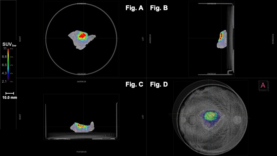 Imaging Case 36:
Head &amp; Neck Cancer - Recurrent Soft Palate Squamous cell Carcinoma